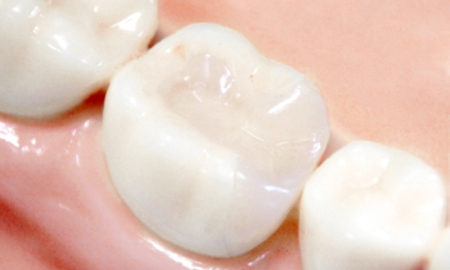 上顎の奥から二番目の歯も保険で白い樹脂の被せ物が使えるようになりました！