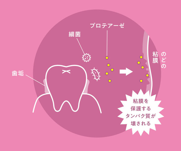 今だからウイルス対策「歯垢の除去で、 ウイルス感染を減らそう! 」