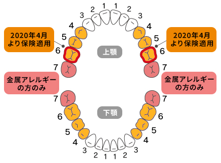 CAD_CAM冠